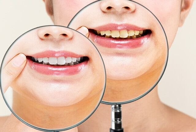 ホワイトニングのBefore Afterを見せる女性